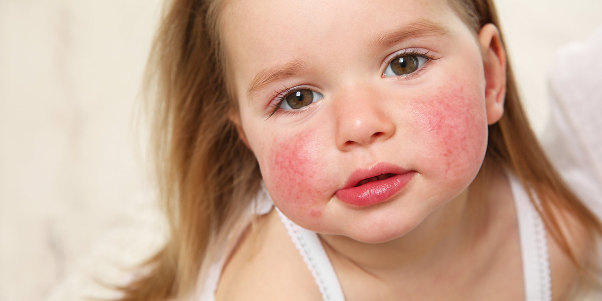 Атопический дерматит у детей: лечение, причины, симптомы и уход